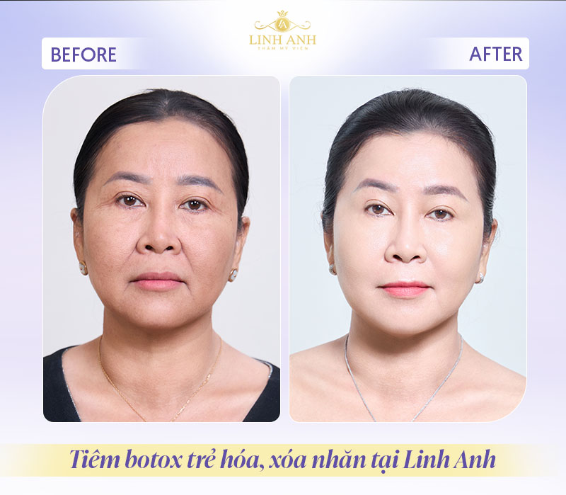 Review tiêm botox xóa nhăn