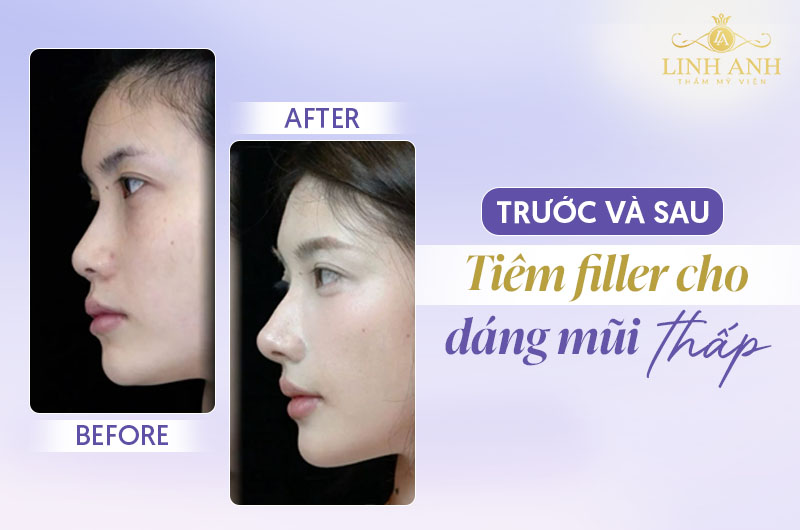 Review tiêm filler mũi Review tiêm filler mũi