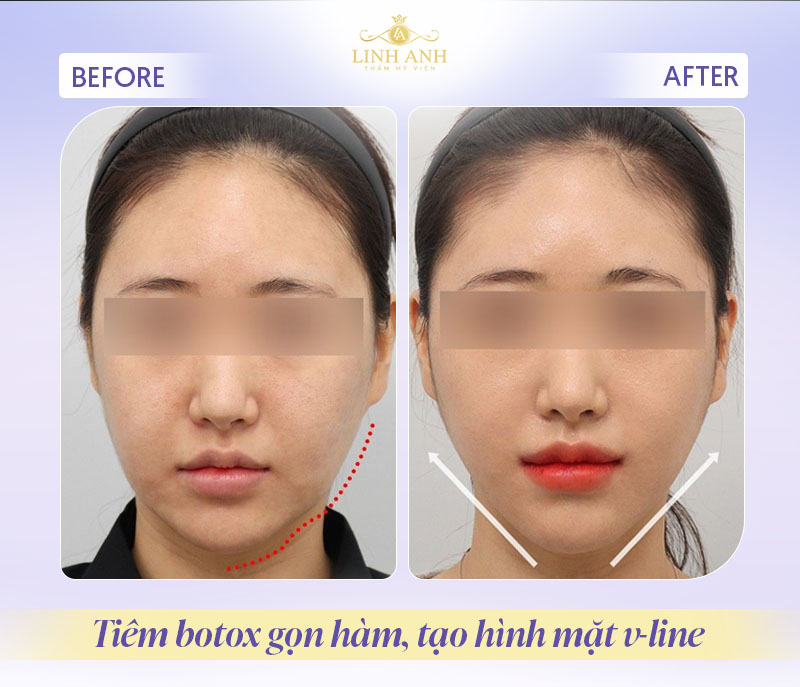 Review tiêm gọn hàm