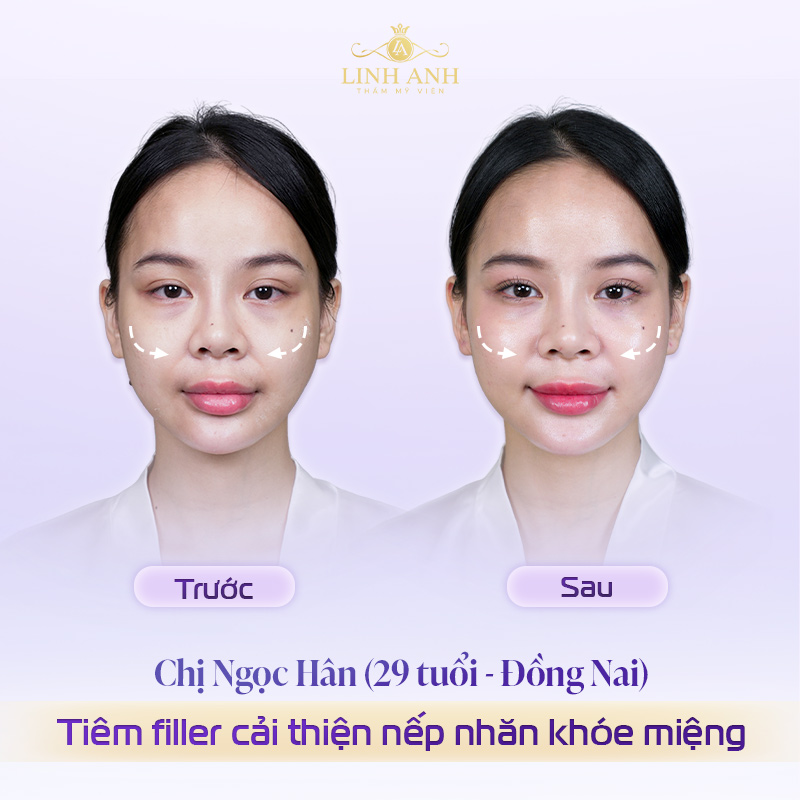 Review tiêm rãnh cười khóe miệng
