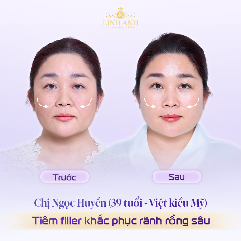 Review tiêm rãnh cười mũi má
