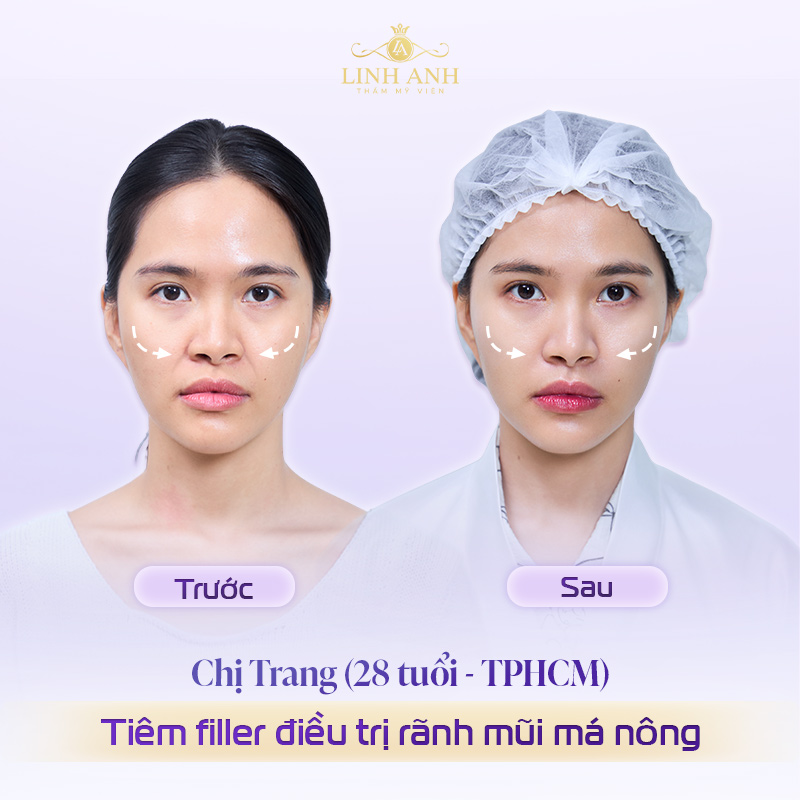 Review tiêm rãnh mũi má