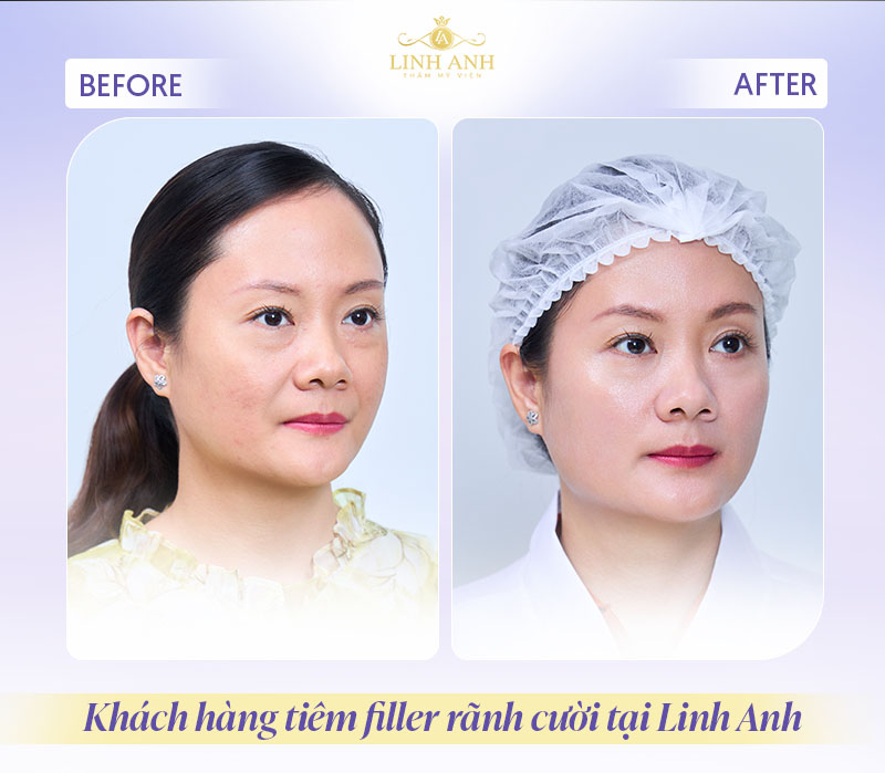 Sau tiêm filler rãnh cười