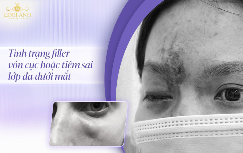 Tác dụng phụ sau tiêm filler mắt