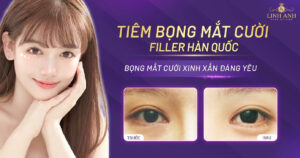 Tiêm bọng mắt cười