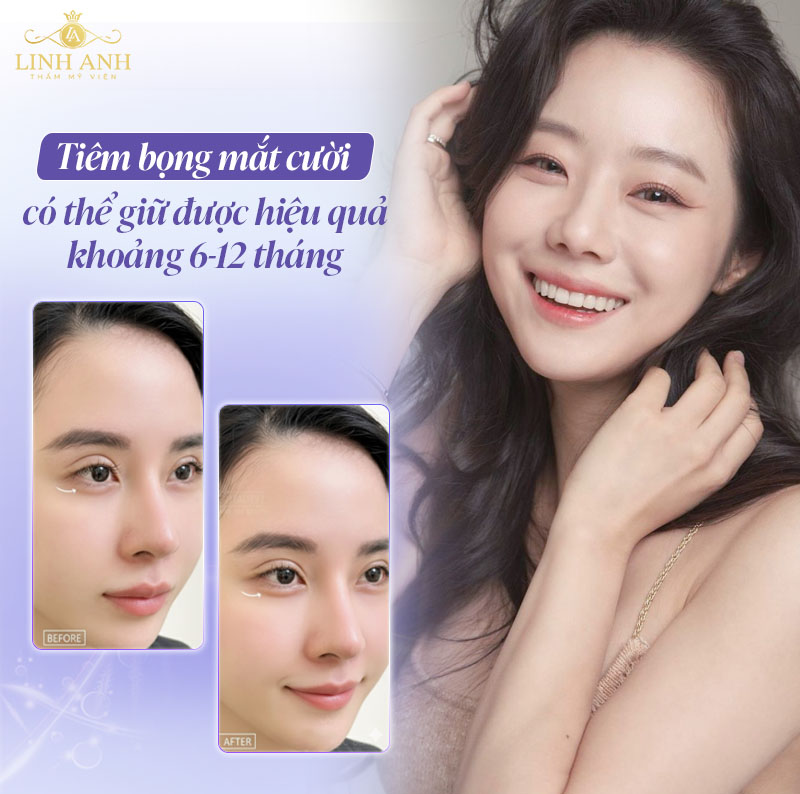 Tiêm bọng mắt cười giữ được bao lâu Tiêm bọng mắt cười giữ được bao lâu