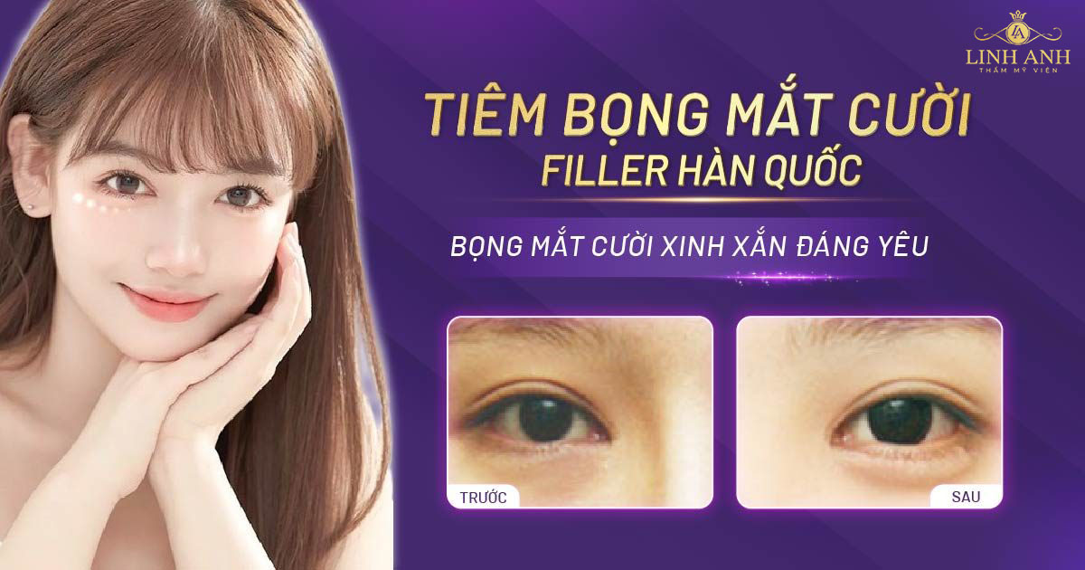 Tiêm bọng mắt cười là gì? Có nguy hiểm không? Giá bao nhiêu?
