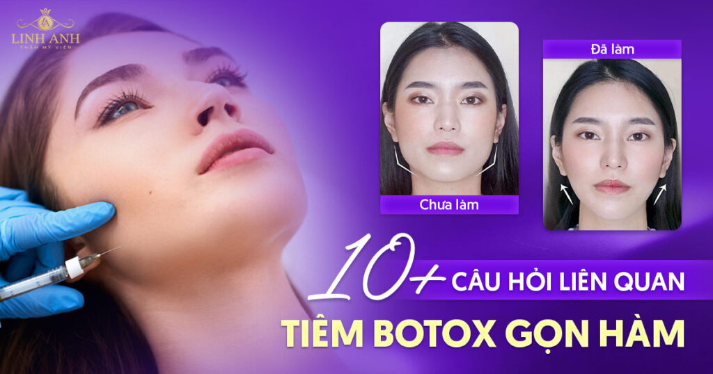 Tiêm botox gọn hàm