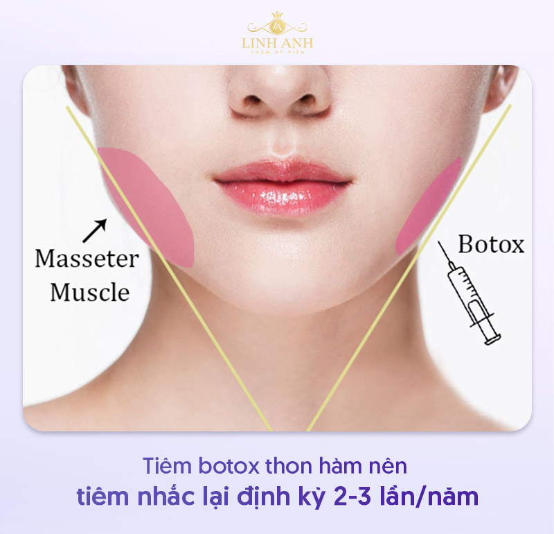 Tiêm botox thon hàm bao lâu thì tiêm lại