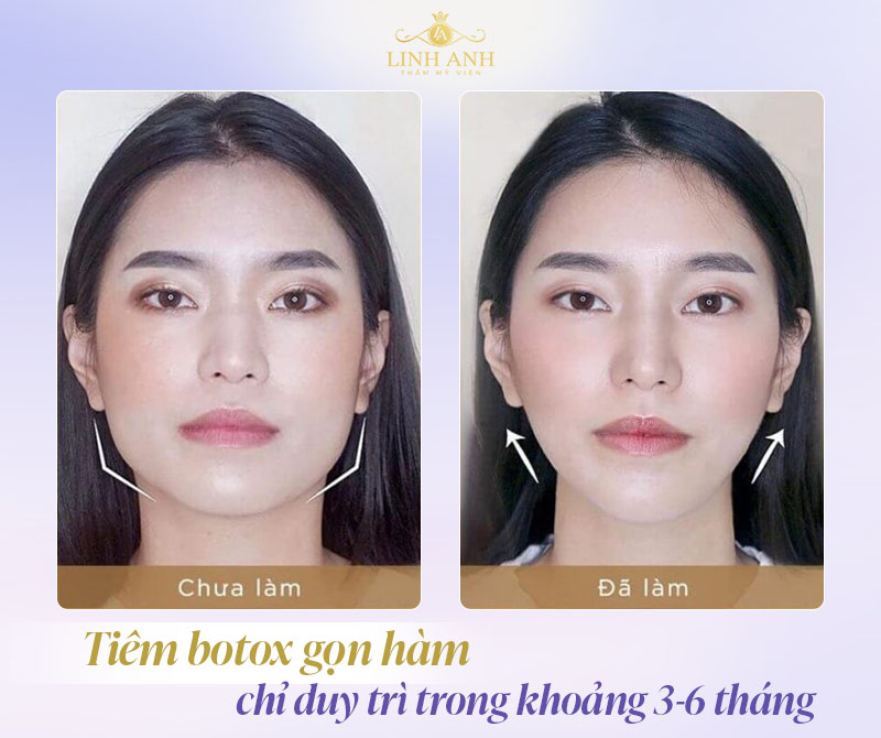 Tiêm botox gọn hàm được bao lâu Tiêm botox gọn hàm được bao lâu
