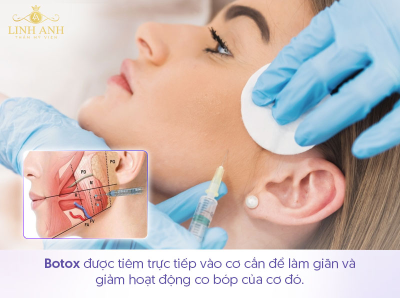 Tiêm botox gọn hàm là gì