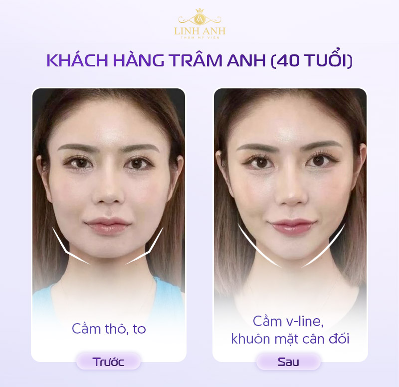 Tiêm botox thon gọn mặt