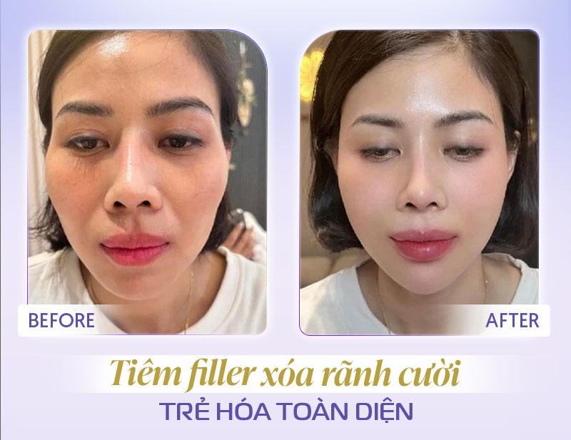 Tiêm chất làm đầy rãnh cười