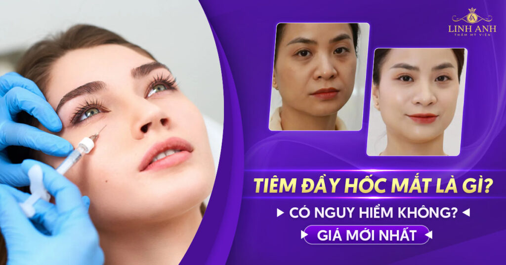 Tiêm đầy hốc mắt