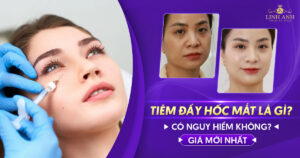 Tiêm đầy hốc mắt
