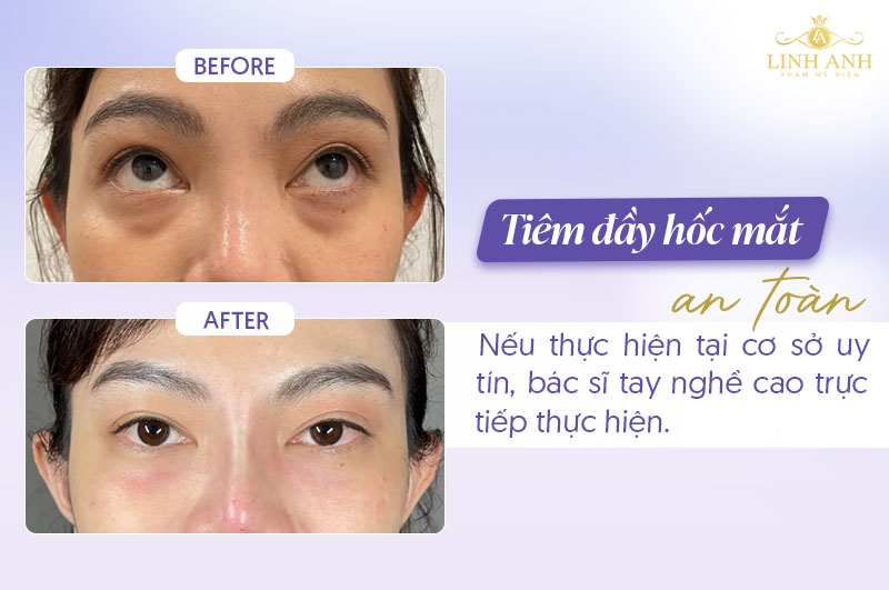 Tiêm đầy hốc mắt có nguy hiểm không