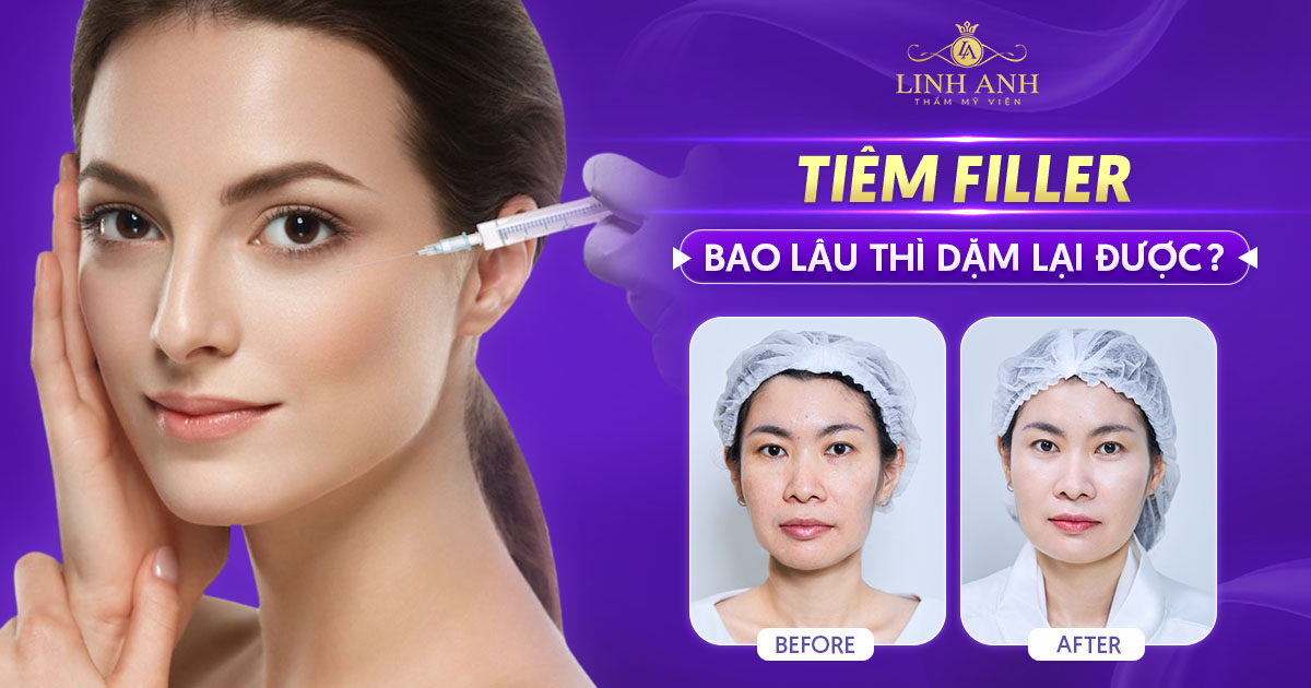Tiêm filler bao lâu thì dặm lại được? Thời gian cụ thể từng vùng