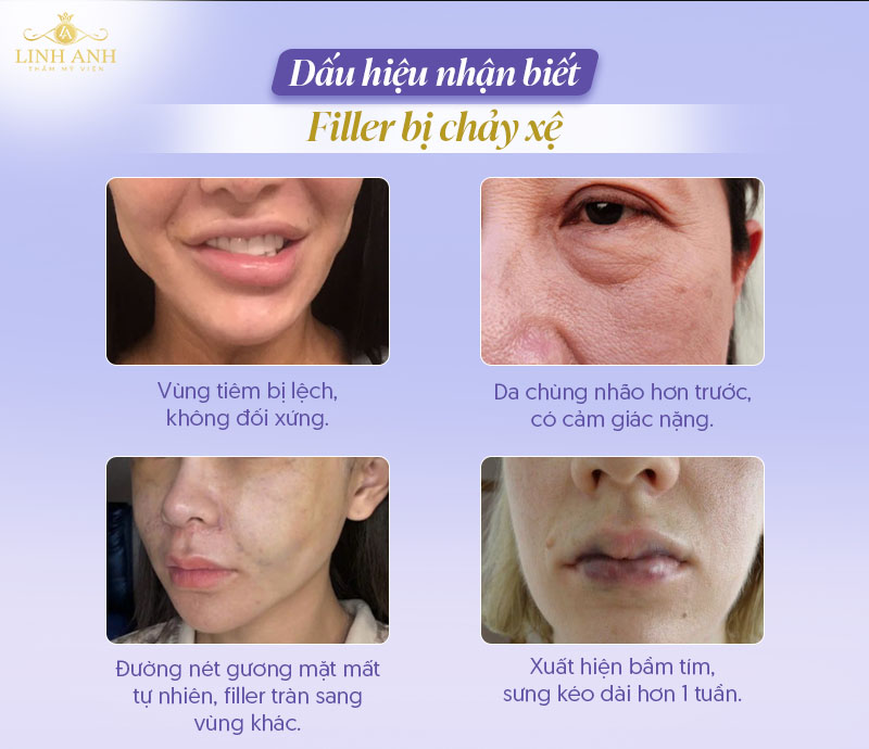 Tiêm filler cằm có bị chảy xệ không