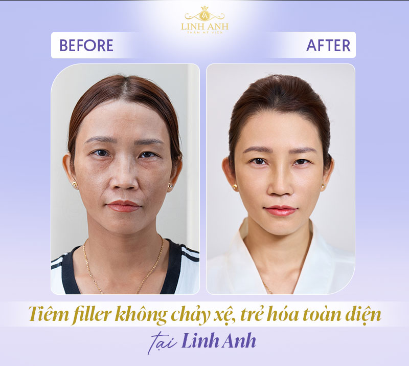 Tiêm filler chuẩn y khoa