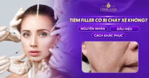Tiêm filler có bị chảy xệ không