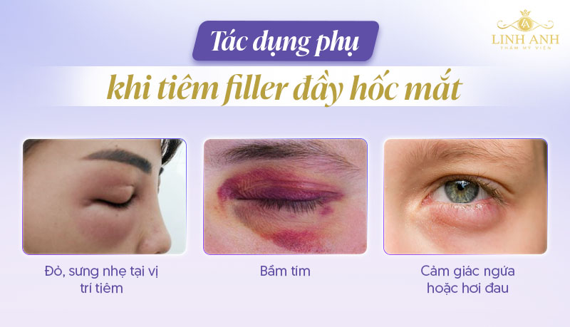 Tiêm filler hốc mắt bị sưng Tiêm filler hốc mắt bị sưng