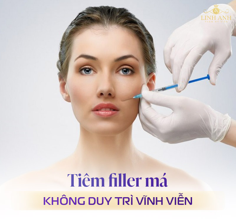 Tiêm filler má baby có vĩnh viễn không