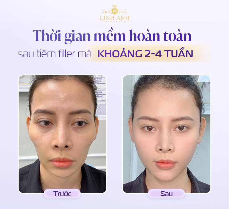 Tiêm filler má bao lâu thì mềm
