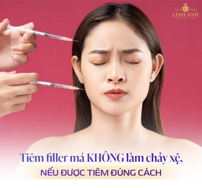 Tiêm filler má có bị chảy xệ không