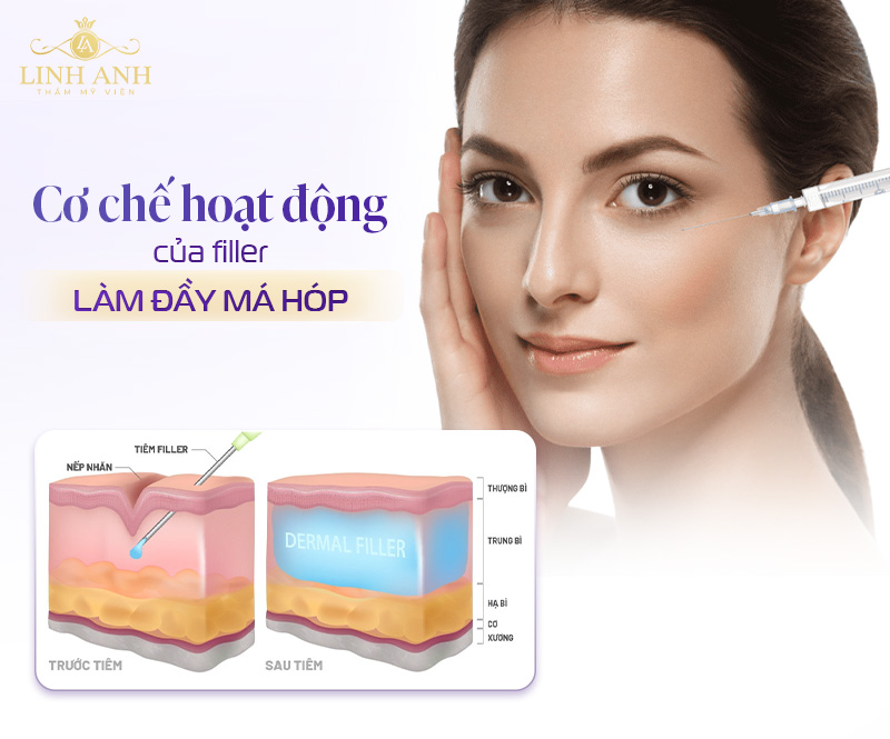 Tiêm filler má là gì