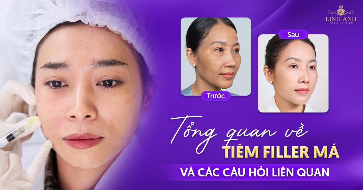 Tổng quan tiêm filler má và giải đáp 10 thắc mắc bạn cần biết