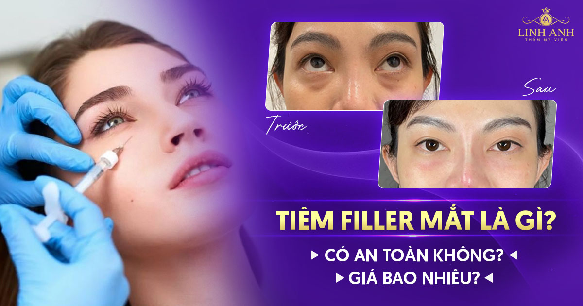 Tiêm Filler mắt có an toàn không? lưu ý những gì?
