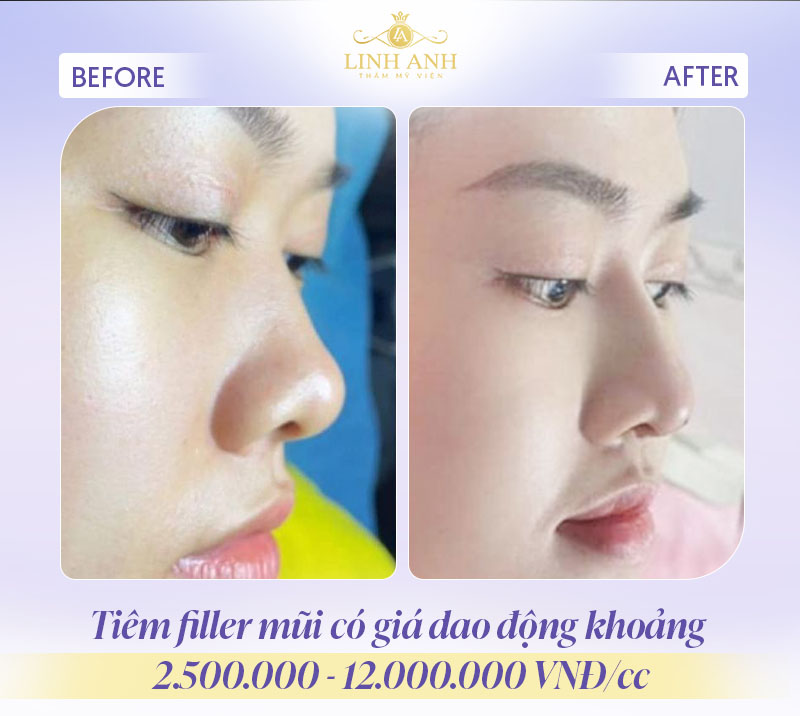 Tiêm filler mũi giá bao nhiêu Tiêm filler mũi giá bao nhiêu