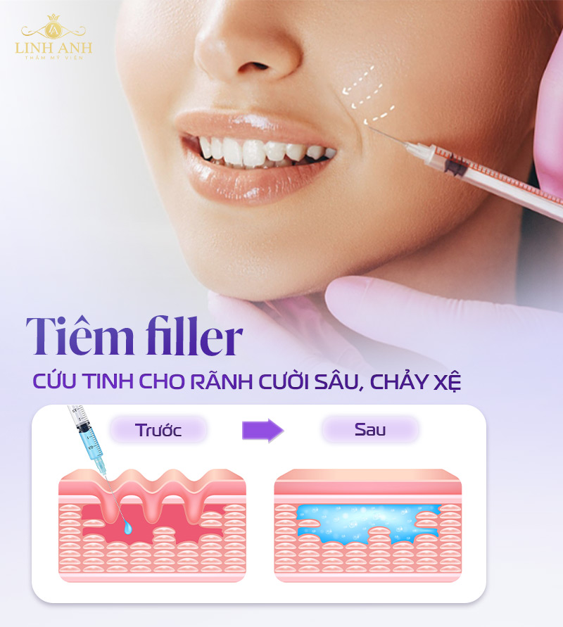 Tiêm filler rãnh cười bao nhiêu tiền