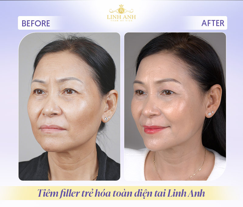 Tiêm filler trẻ hóa tại phòng khám Linh Anh Tiêm filler trẻ hóa tại phòng khám Linh Anh