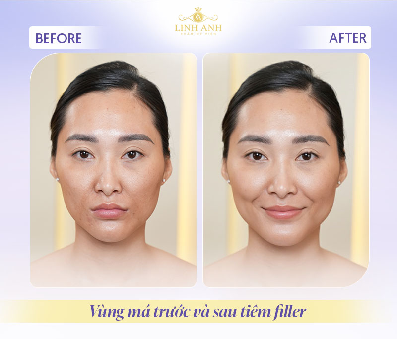 Tiêm filler vùng má Tiêm filler vùng má