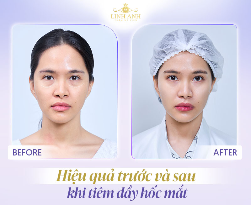 Tiêm ha làm đầy hốc mắt