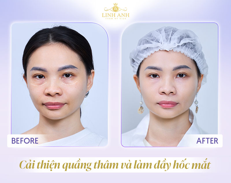 Tiêm hốc mắt trị thâm