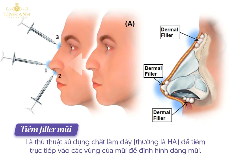 Tiêm mũi filler Tiêm mũi filler