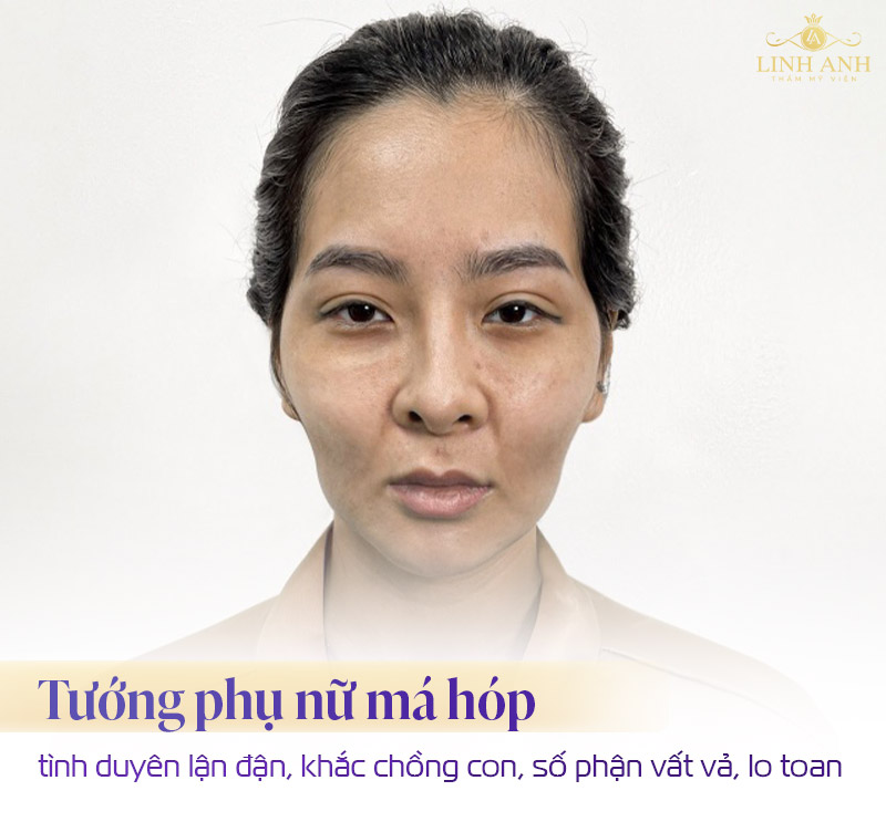 Tướng phụ nữ má hóp Tướng phụ nữ má hóp