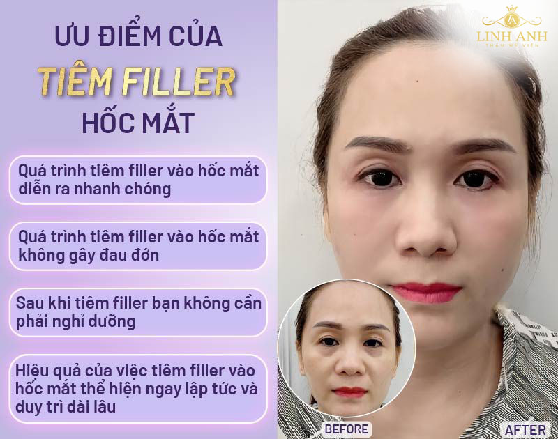 Ưu điểm Tiêm ha làm đầy hốc mắt Ưu điểm Tiêm ha làm đầy hốc mắt