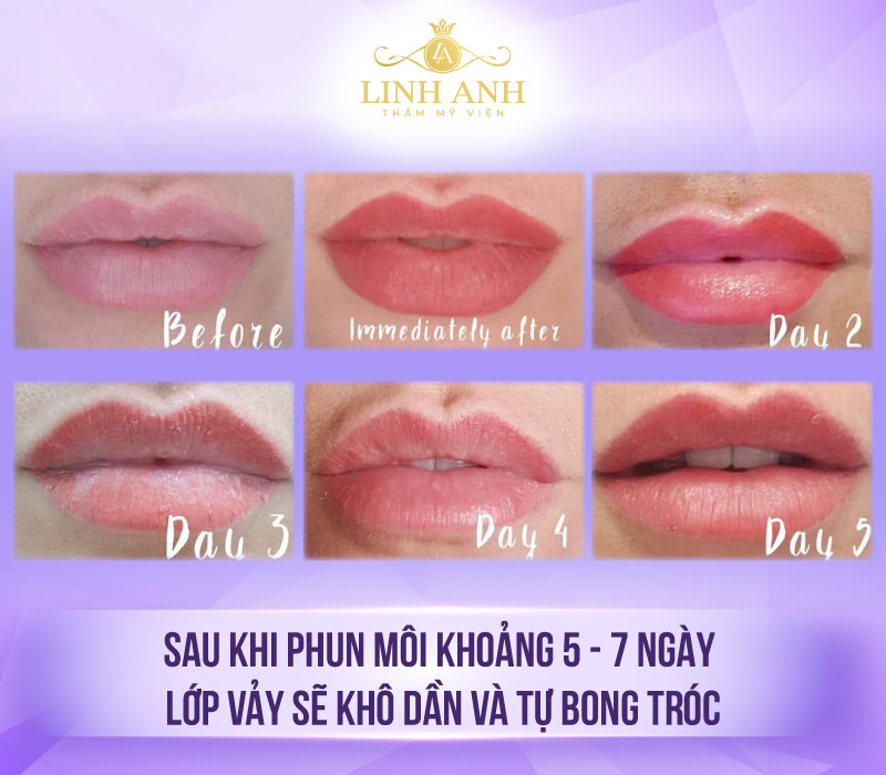 Xăm môi bị bong da nhiều lần có sao không