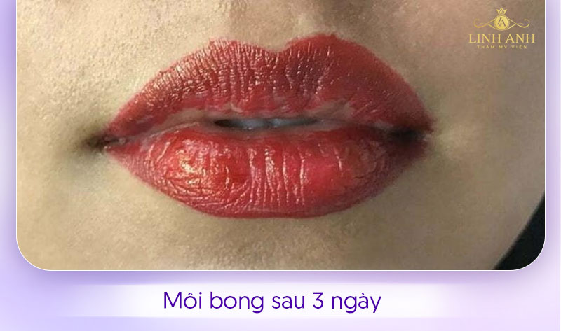 Hình ảnh môi bong sau 3 ngày