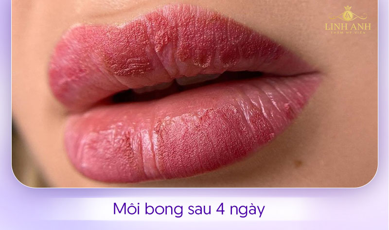Hình ảnh môi bong sau 4 ngày