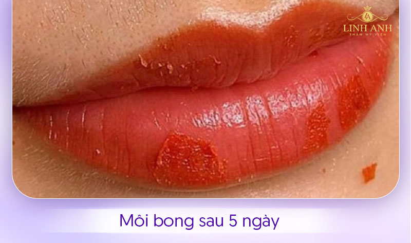 Hình ảnh môi bong sau 5 ngày