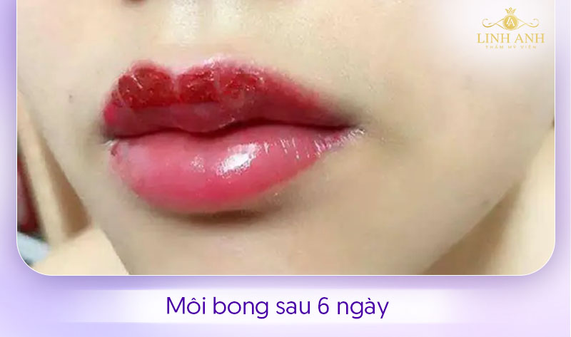 Hình ảnh môi bong sau 6 ngày