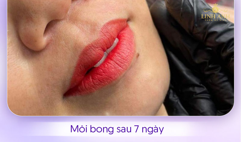 Hình ảnh môi bong sau 7 ngày
