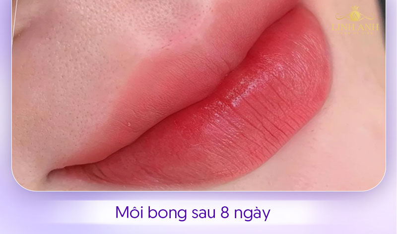 Hình ảnh môi bong sau 8 ngày