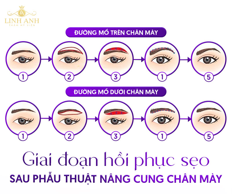 nâng cung chân mày bao lâu thì hết sẹo nâng cung chân mày bao lâu thì hết sẹo
