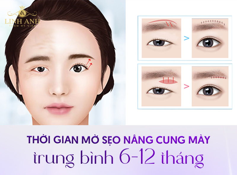 nâng cung chân mày xong khi nào thì hết sẹo nâng cung chân mày xong khi nào thì hết sẹo