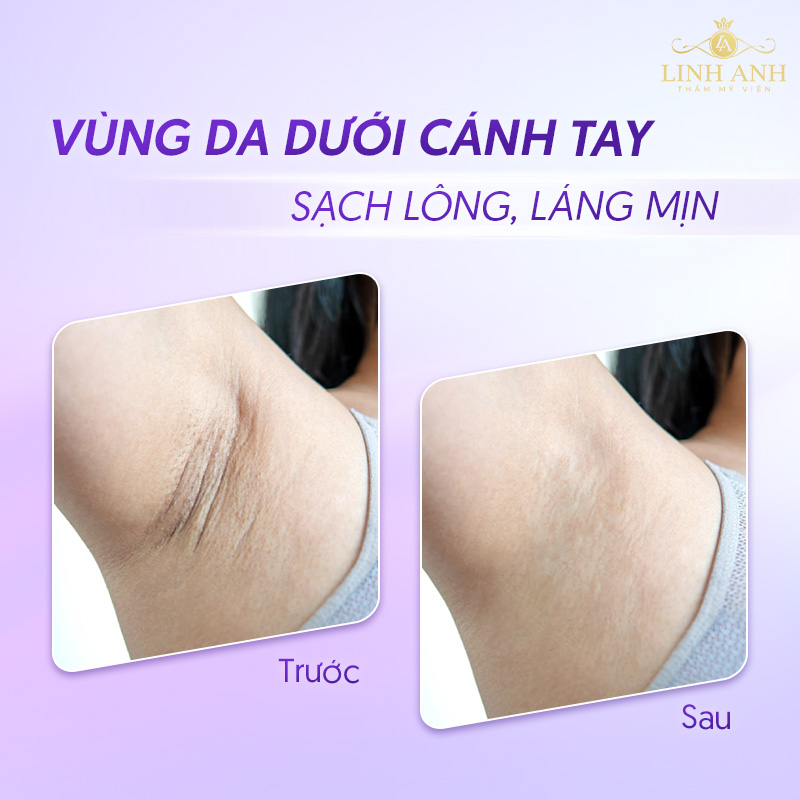 Review triệt lông nách ở tuổi dậy thì